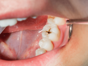 Paciente com cárie no dente